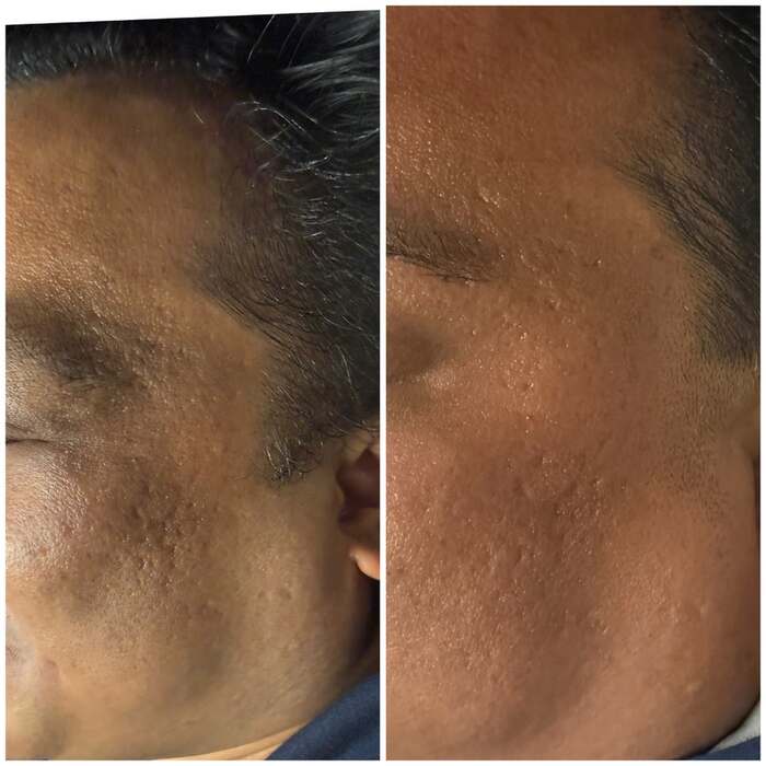 Before and after a course of treatment at Envy Skin Studio, example 10 of 16