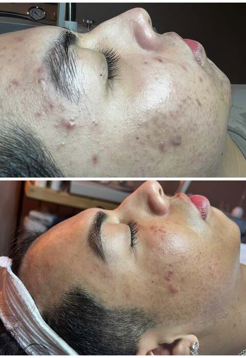 Before and after a course of treatment at Envy Skin Studio, example 11 of 16