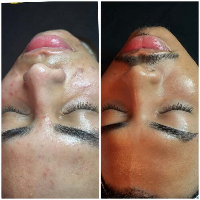 Before and after a course of treatment at Envy Skin Studio, example 13 of 16