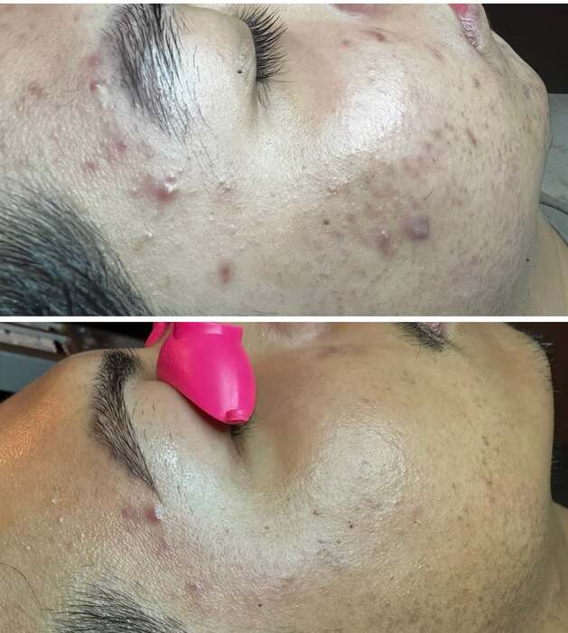 Before and after a course of treatment at Envy Skin Studio, example 15 of 16