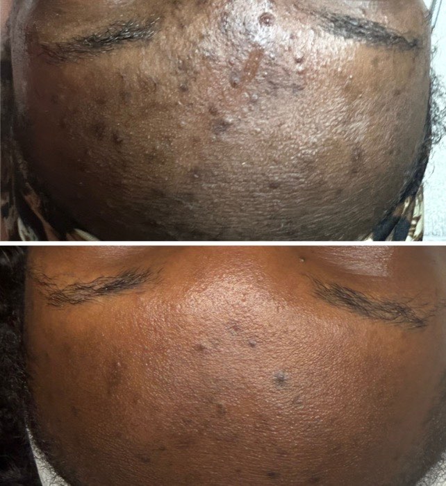 Before and after a course of treatment at Envy Skin Studio, example 9 of 16